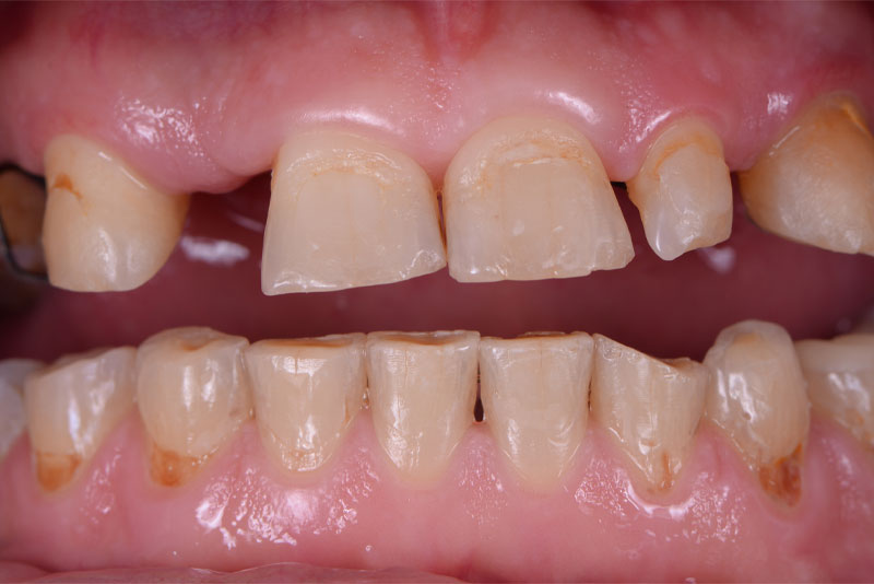 before dental implants