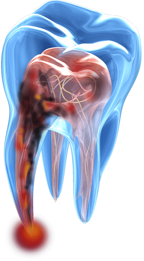 tooth infected model
