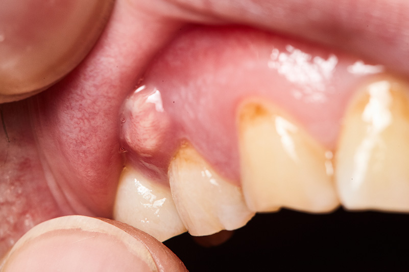 inflammation of the gums abscess closeup