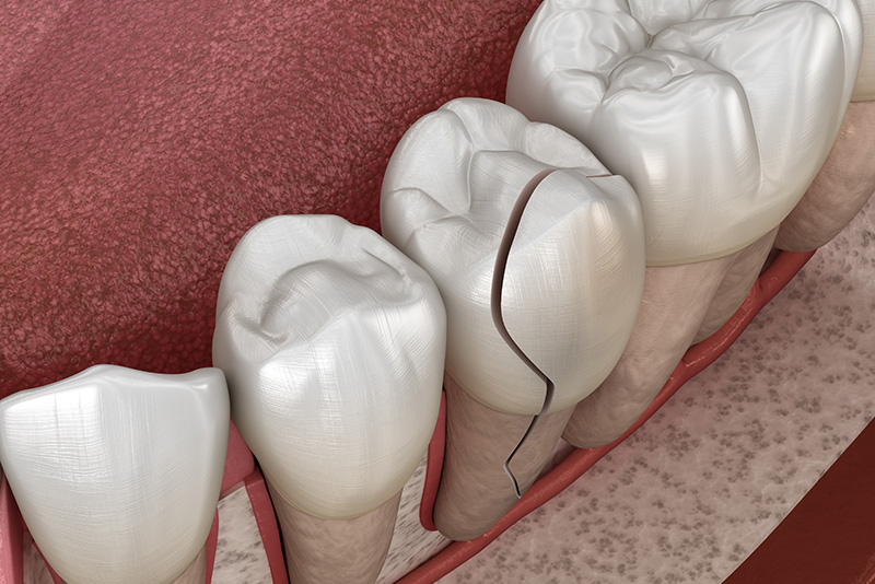 Cracked tooth, splitted. Medically accurate 3D illustration