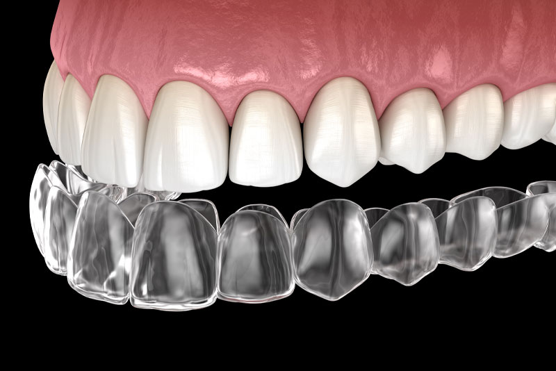 Invisalign model