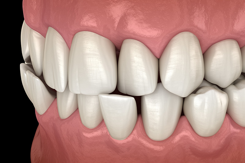 Anterior crossbite dental occlusion