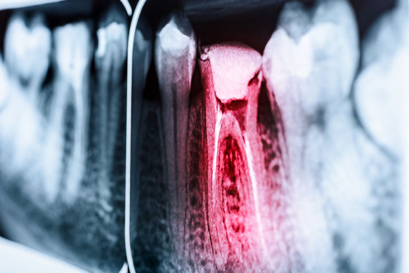 root-canal-xray