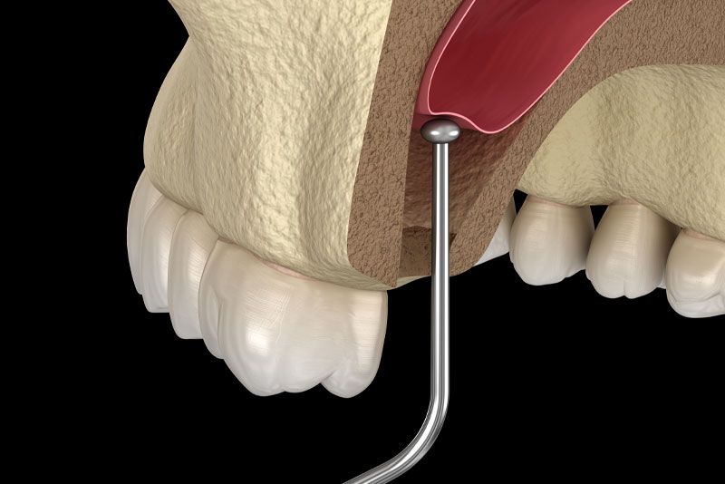 sinus-lift-model