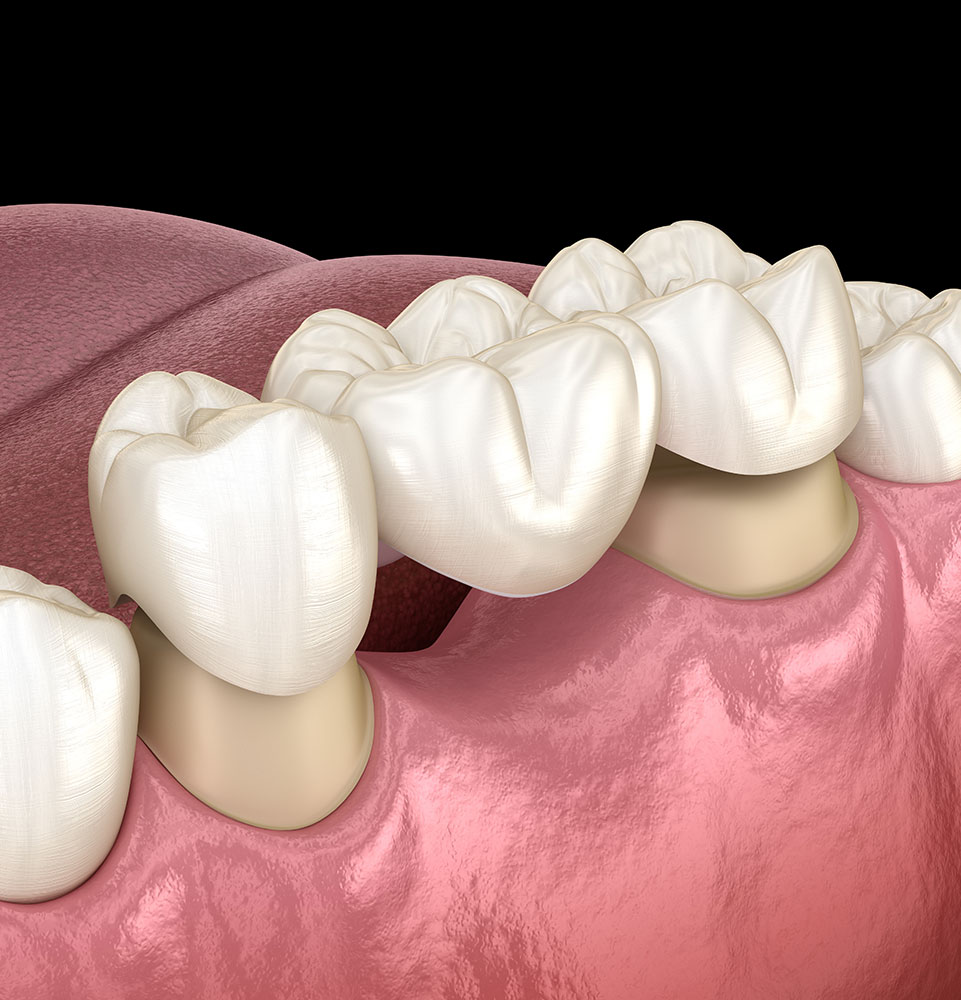 dental bridge