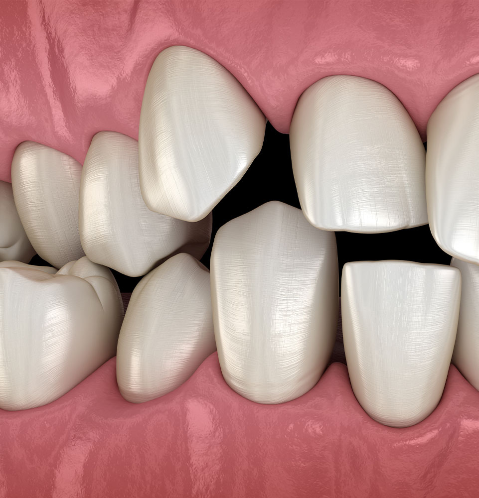 3d model of crooked teeth