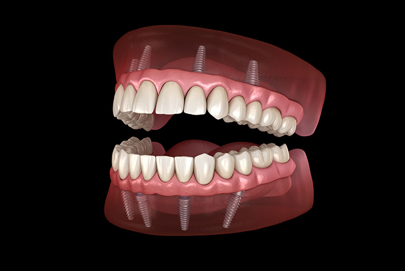 full arch dental implants