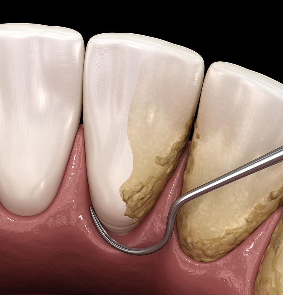 unhealthy gums with tartar