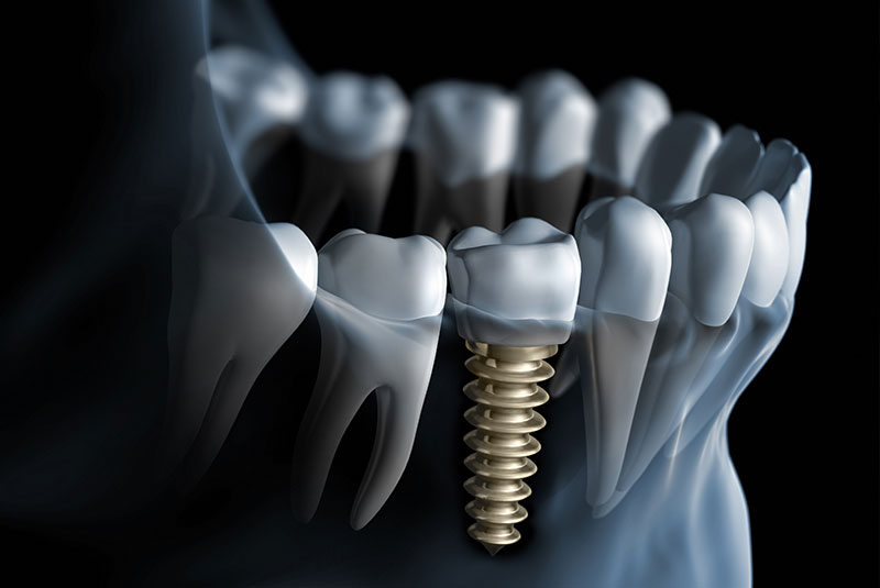 dental implants