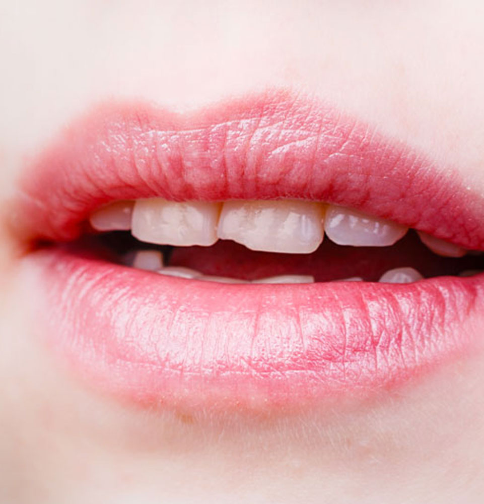 dental patient in need of veneers
