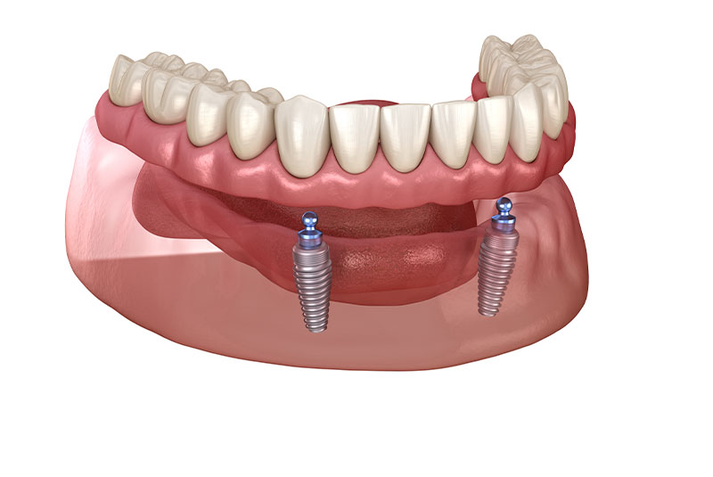 snap on dentures