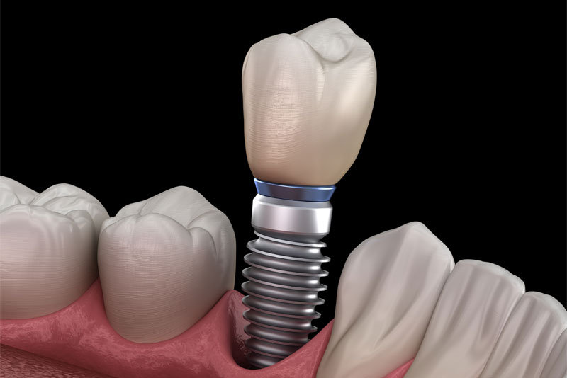 single dental implant model