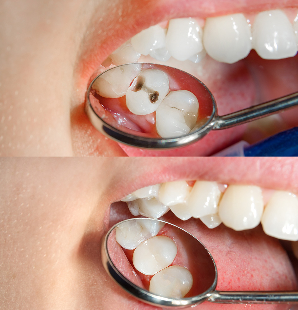 dental Inlays and Onlays before and after