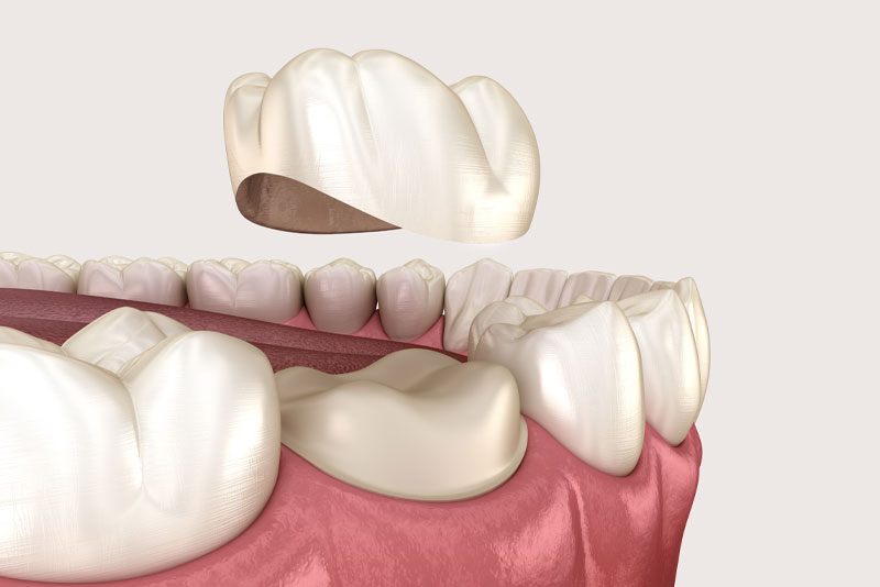 dental-crown-model