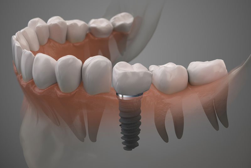 dental-implants model