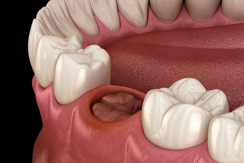 The blood clot seals off the tooth after extraction
