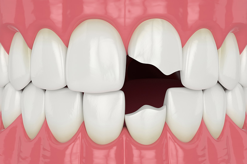 3d render of jaw with broken incisors teeth
