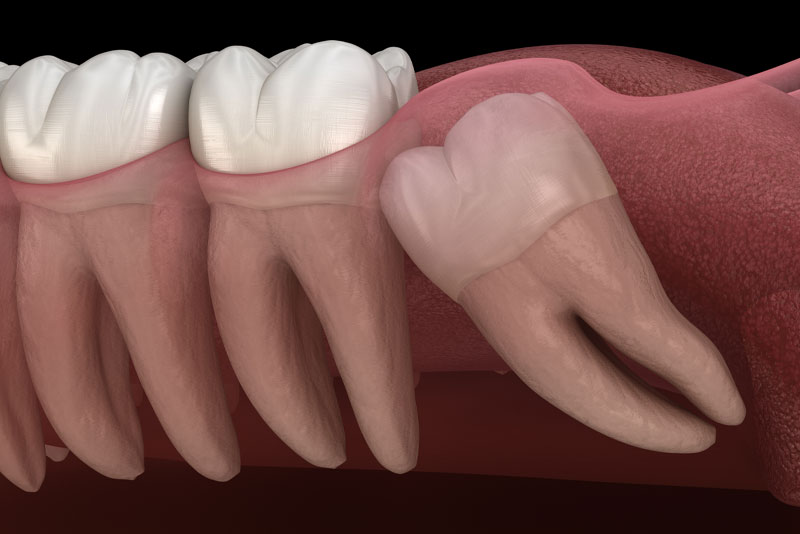 impacted-wisdom-tooth-model