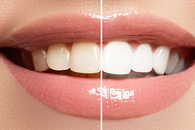 teeth-whitening-before-and-after