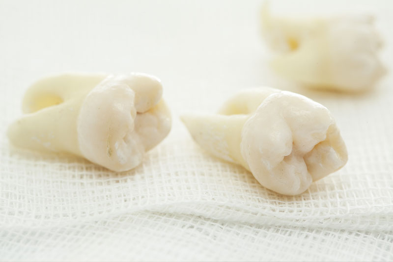tooth extraction model