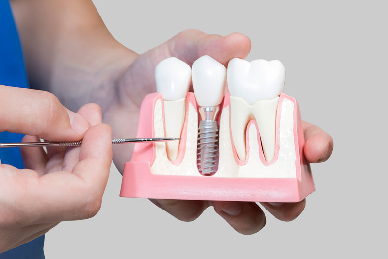a dentist holding a dental implant model showing a single dental implant post and crown prosthetic.