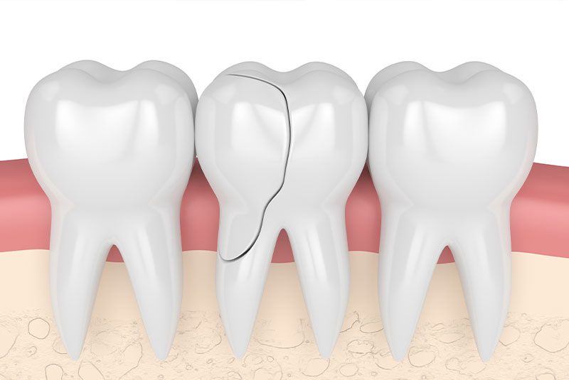 3d render of cracked tooth