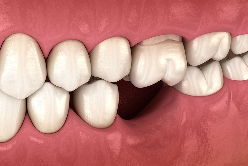 dislodged tooth 3d render